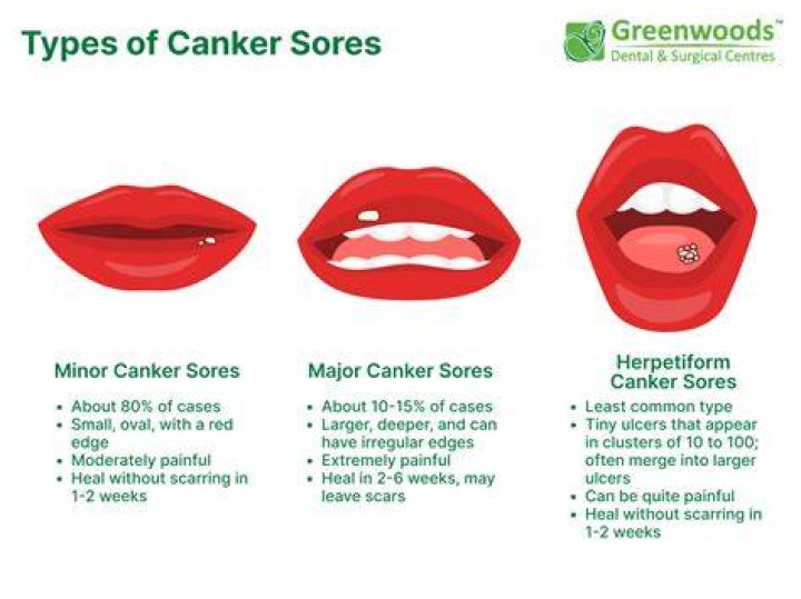 What are the stages of canker sores?